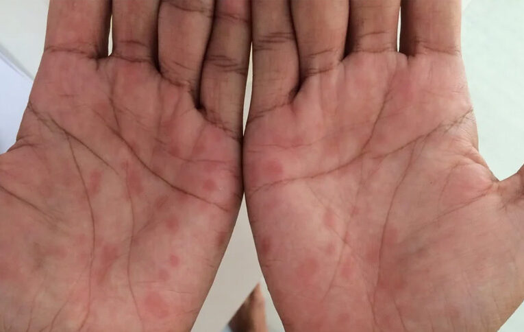 Alerta por el aumento sostenido de casos de sífilis en el país y la región